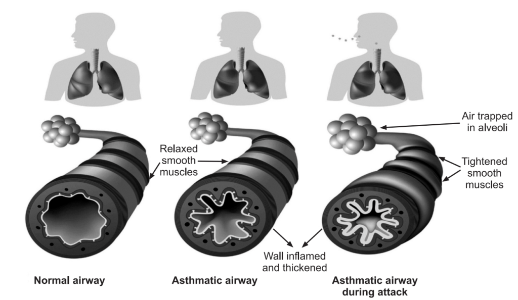Normal and inflamed airway wall in asthma