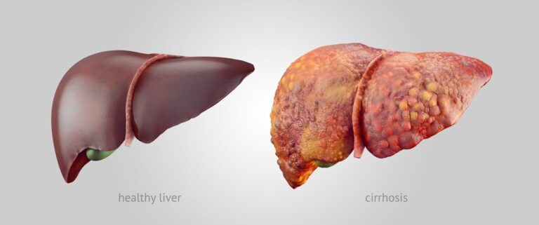 Alcoholic liver Disease