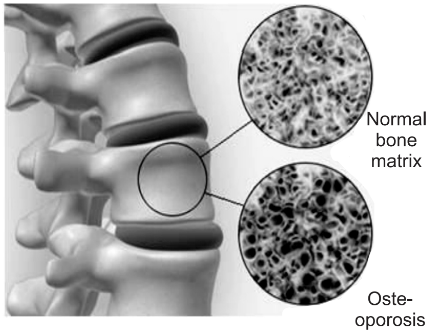 Normal and Osteoporosis bone