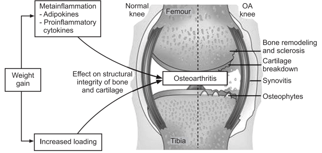 Pathogenesis of Osteoarthritis