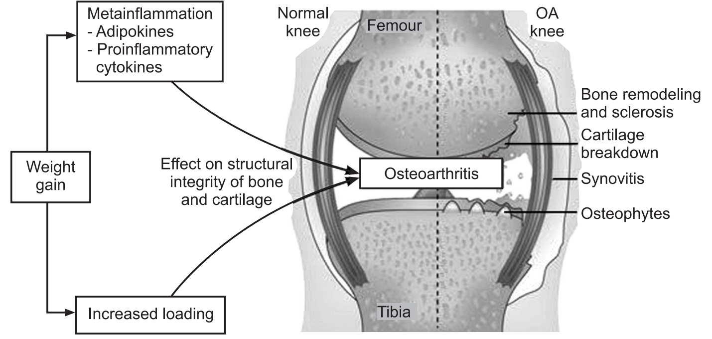 Osteoarthritis - Types, Causes, Symptoms, Treatments