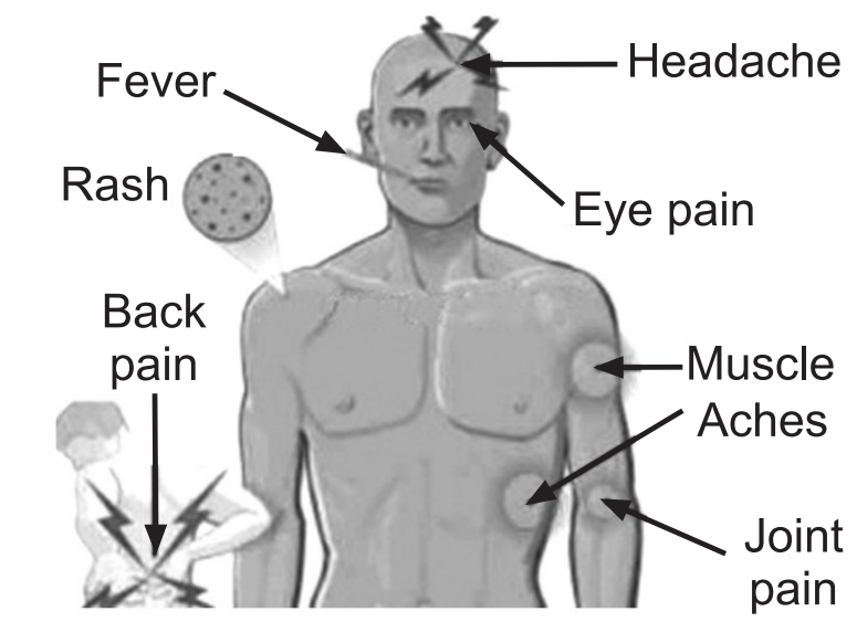 Symptoms of typhoid