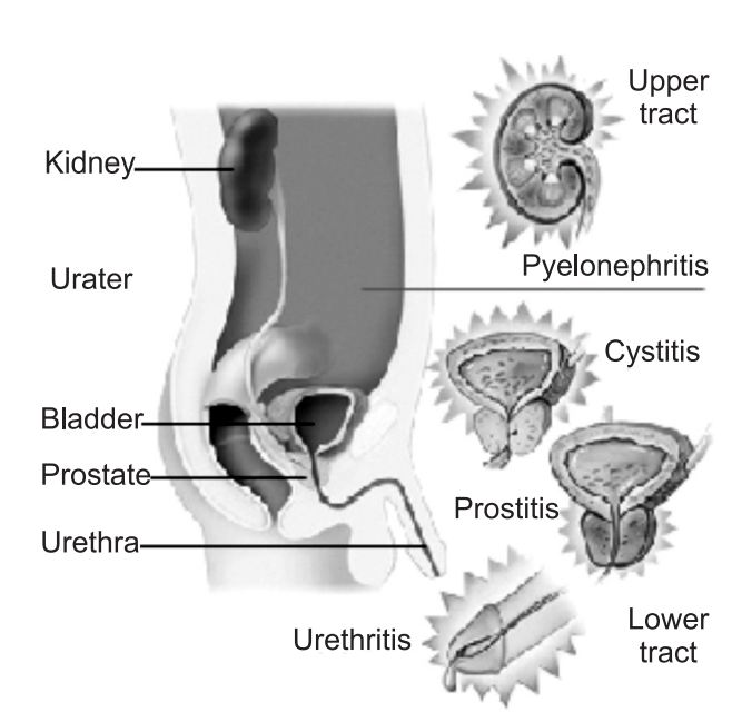 Urinary tract infections